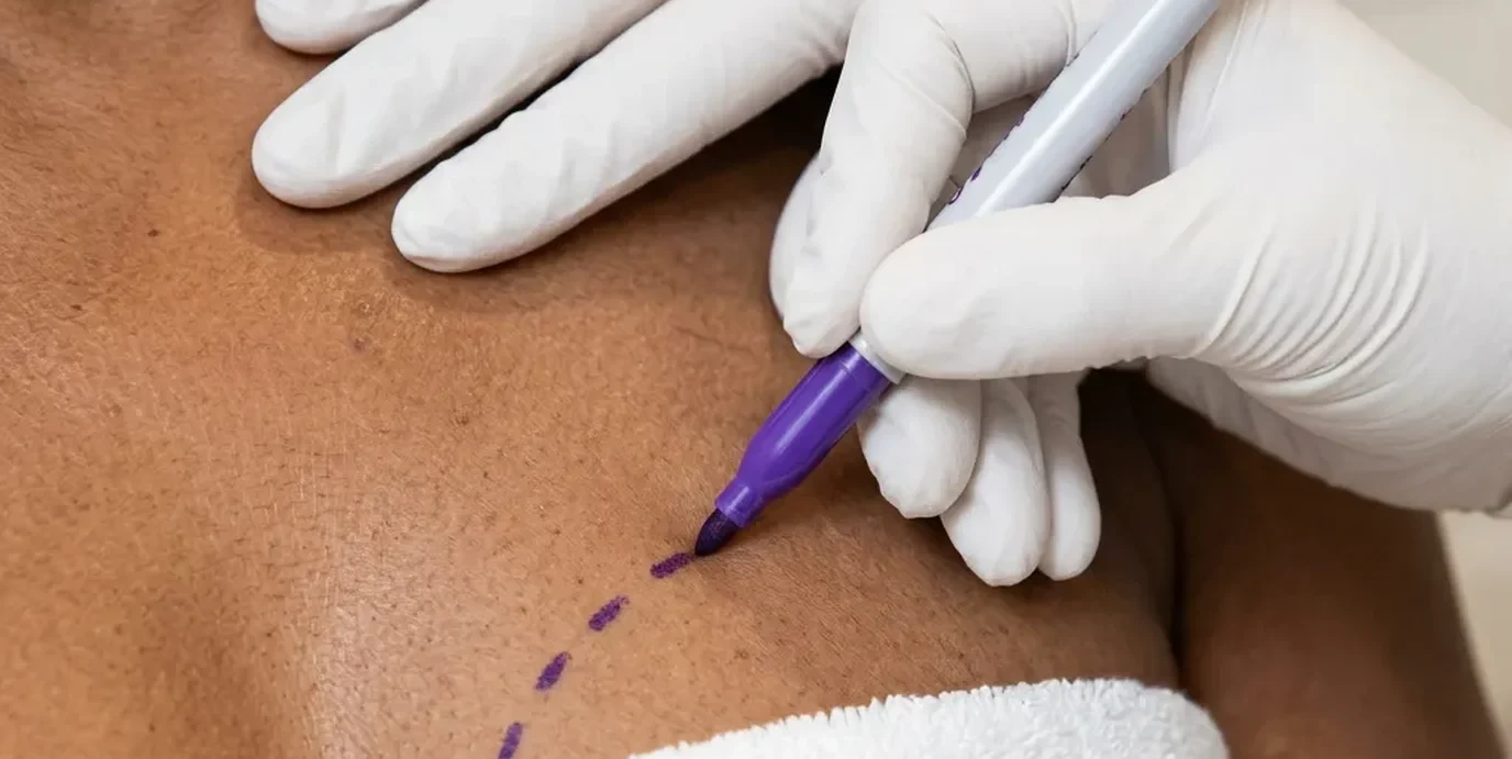 Breast Lift
