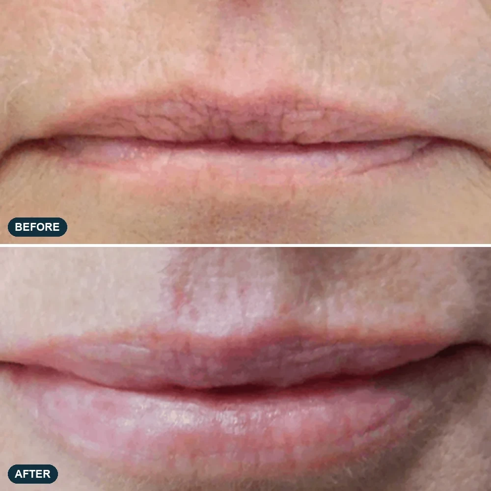 Lips, front view, before and after clinical case supplied by the manufacturer