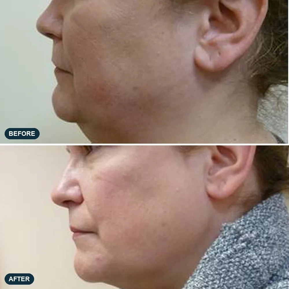 Under the Chin, side view, before and after at Barrie Plastic Surgery