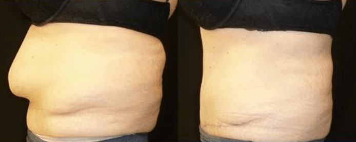 ABDOMINOPLASTY PAGE - BEFORE AND AFTER