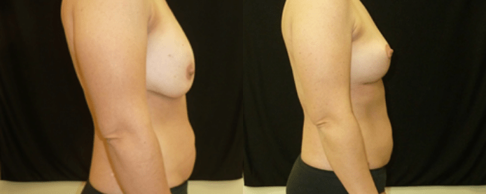 BREAST AUGMENTATION PAGE -BEFORE AND AFTER