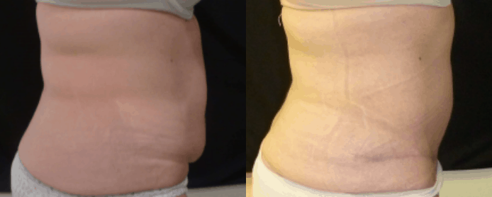 ABDOMINOPLASTY -BEFORE AND AFTER