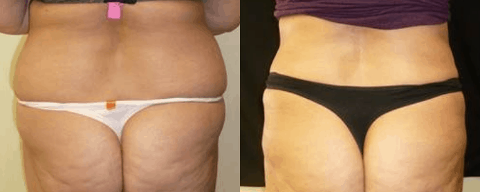 ABDOMINOPLASTY - BEFORE AND AFTER
