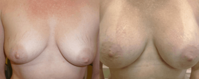 BREAST AUGMENTATION - BEFORE AND AFTER