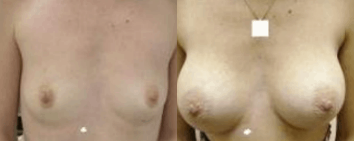BREAST AUGMENTATION - BEFORE AND AFTER